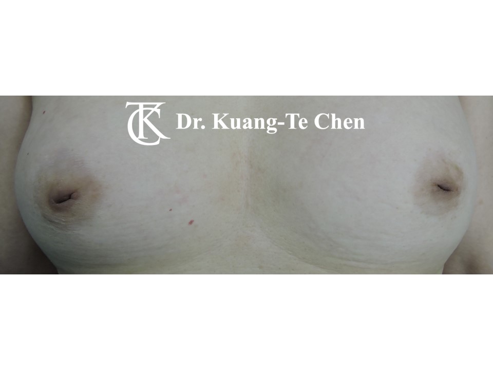 乳頭凹陷術前
