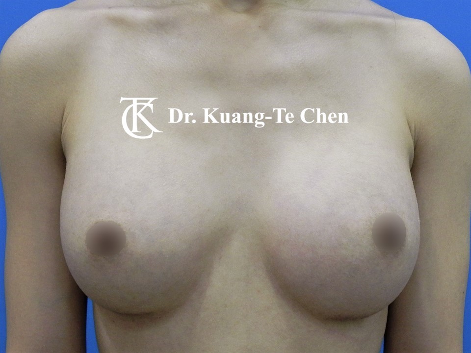 內視鏡隆乳術後