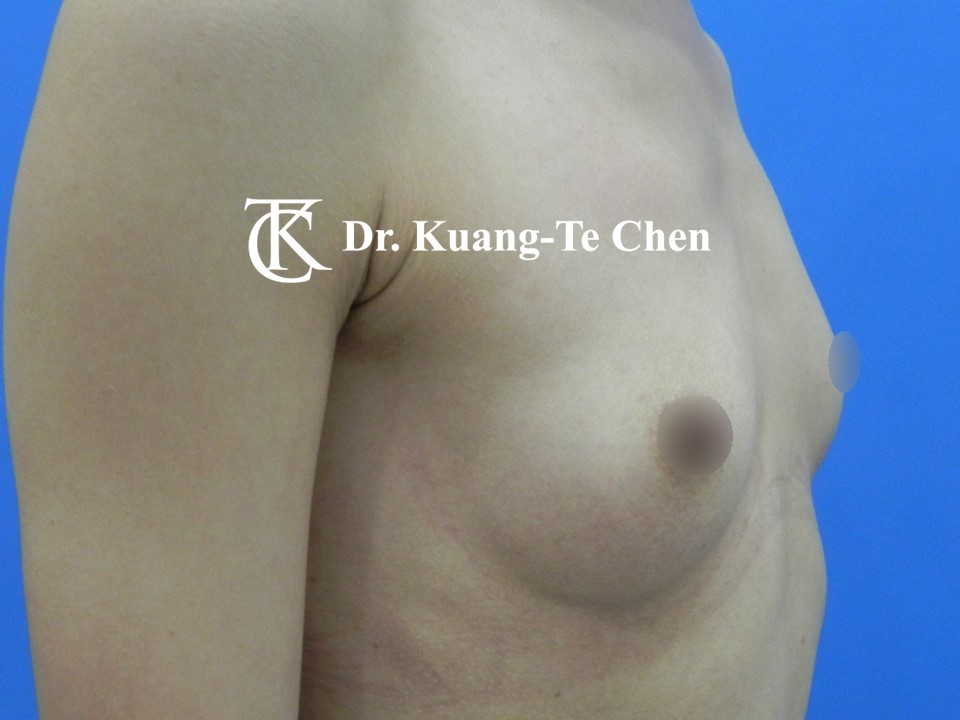 內視鏡隆乳術前
