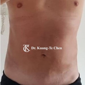 威塑體雕抽脂術後case 1
