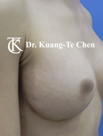 內視鏡隆乳術後