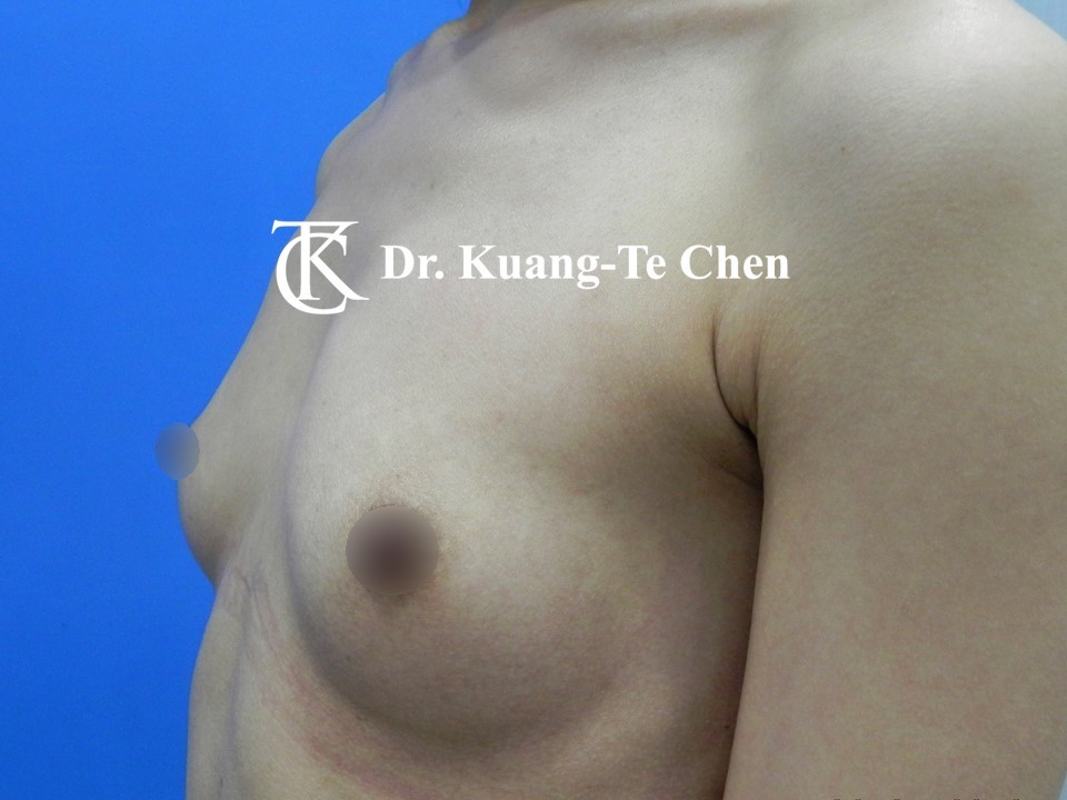 內視鏡隆乳術前