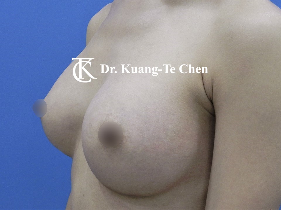 內視鏡隆乳術後