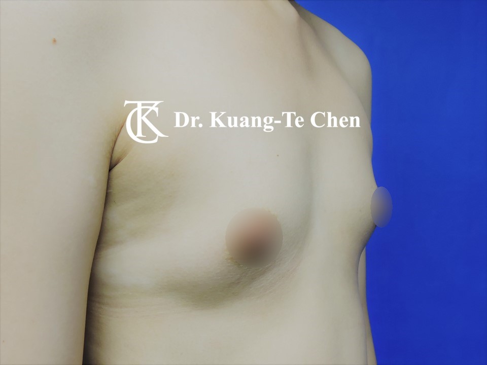 內視鏡隆乳術前