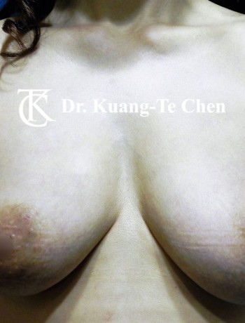 義乳取出置換自體脂肪術後