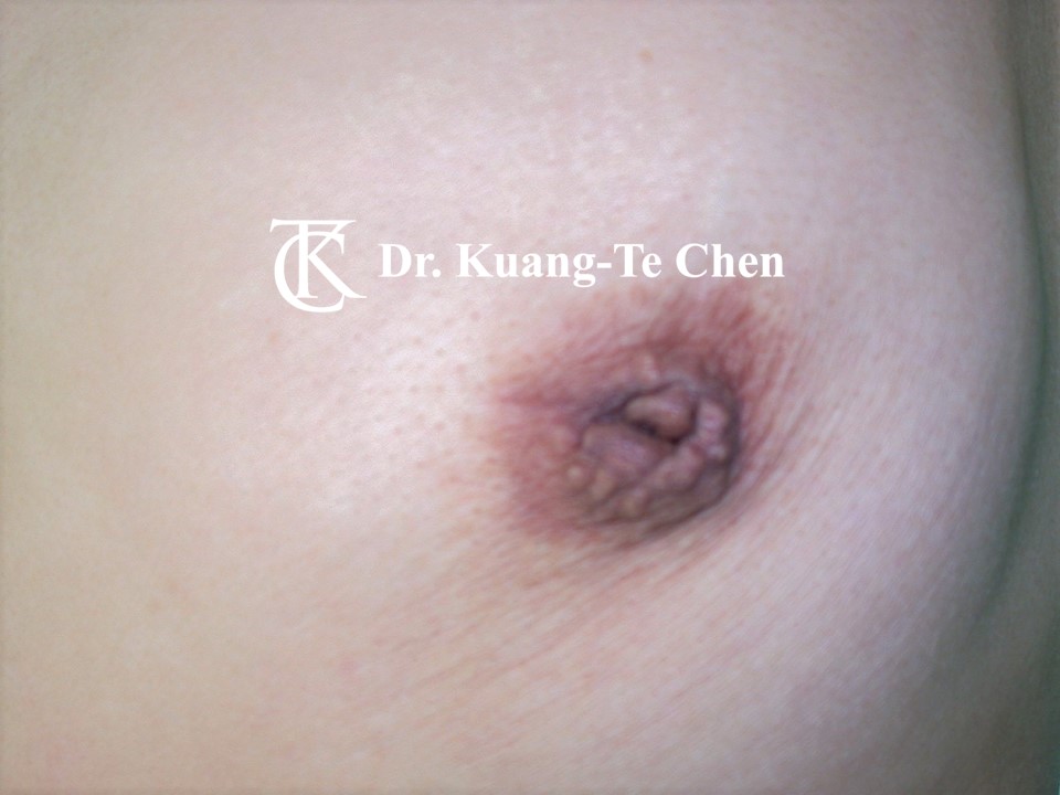 乳頭凹陷術前