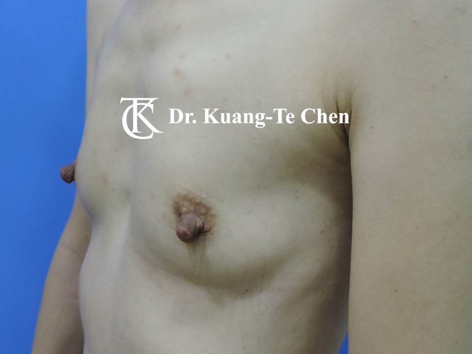 乳頭縮小術前