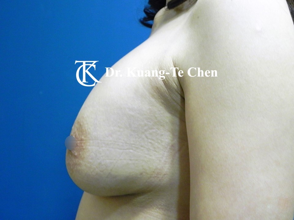 義乳取出置換自體脂肪術前