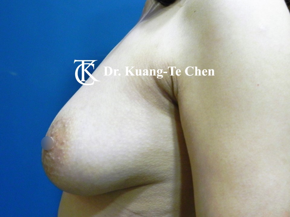 義乳取出置換自體脂肪術後