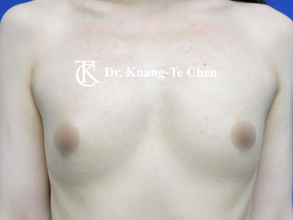 內視鏡隆乳術前