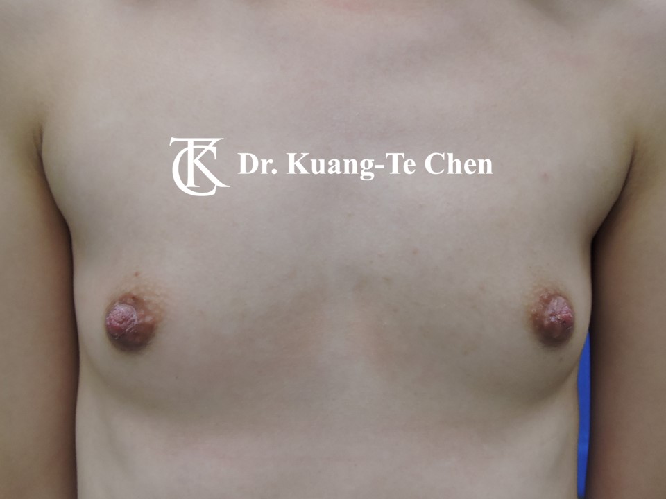 乳頭縮小術後