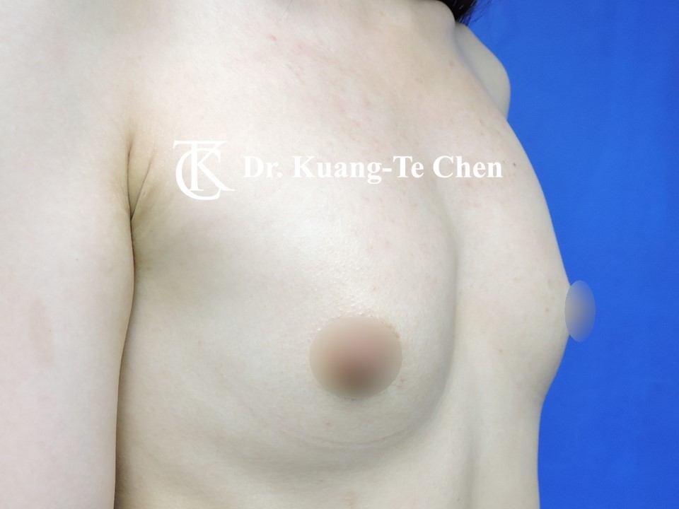 內視鏡隆乳術前