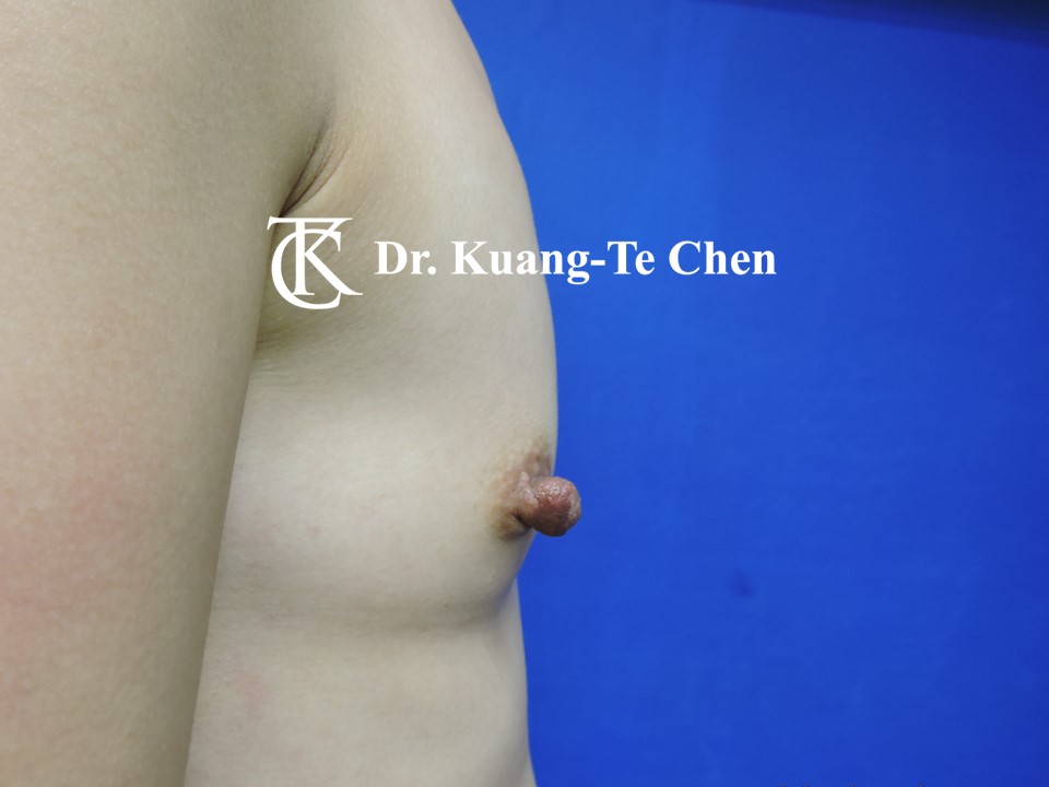 乳頭縮小術前